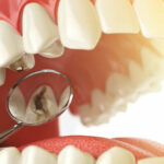 Why No Dairy After Dental Implant